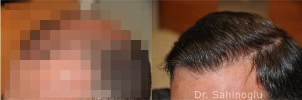 Haarlinie bei Haartransplantation